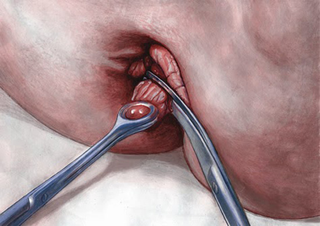 Illustration for article titled Penyakit Wasir Ke Dokter Apa